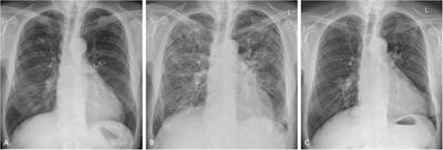 Methotrexate-Associated Pneumonitis and Rheumatoid Arthritis-Interstitial Lung Disease: Current Concepts for the Diagnosis and Treatment